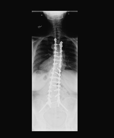 FIXED-WHOLE-SPINE-SCOLI-AP-after-0001